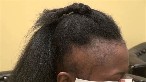 Black Woman Bald Receding Hairline Hair Loss Transplant Restoration