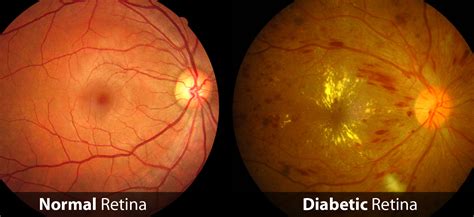 Diabetic Retinopathy Dallas Saland Vision Eye Doctor Dallas