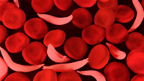Sickle cell anemia (sickle cell disease) is a blood disease that shortens life expectancy. New NIH studies seek adults and families affected by ...