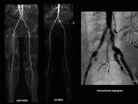 Peripheral Angiogram And Angioplasty Hariharan Diabetes And Heart Care