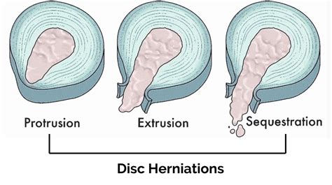 Three Basic Types Of Disc Herniation Nj Spine Orthopedic My Xxx Hot Girl