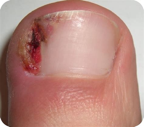 Toe Nail Disorders Fremont Foot And Ankle