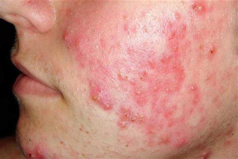 Acne Vulgaris How Much We Know Health Vision