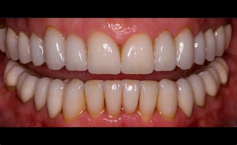 Full Mouth Rehabilitation California Smile Dental Studio