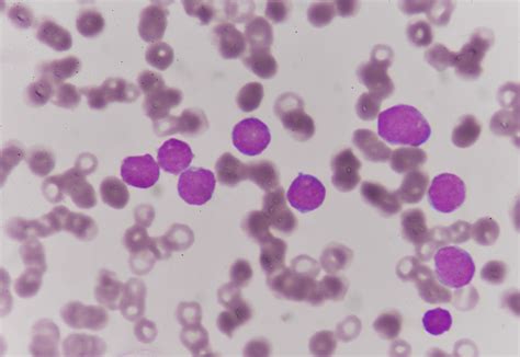Blood Disease Leukemia Cancer Treatment Britannica