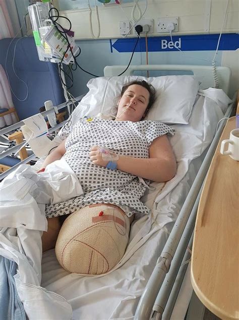 Woman 24 Has Her Painful Leg Amputated And She Couldn T Be Happier Hull Live