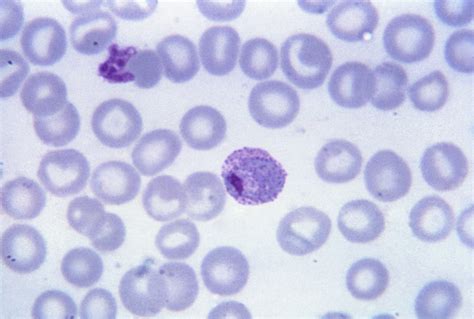 Malaria Parasite Accumulates Undetected In Bone Marrow