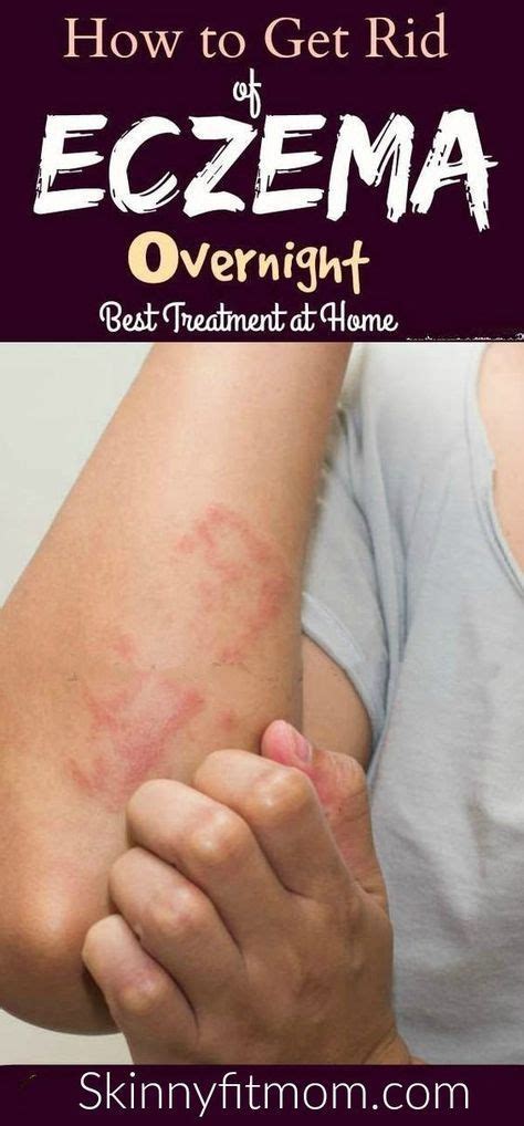 13 Home Remedies To Get Rid Of Eczema That Really Work Get Rid Of