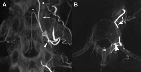 Imaging Of Dural Arteriovenous Fistula Radiologic Clinics
