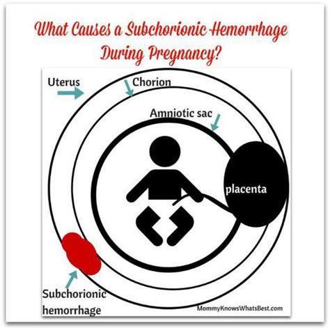 What Causes Subchorionic Hemorrhage In Pregnancy Pregnancy