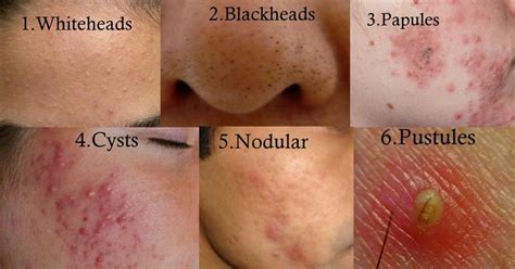 Types Of Acne Back Acne Treatment Diy Acne Treatment Cystic Acne