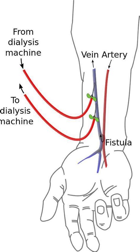 Fistula For Hemodialysis Dialysis Interventional Radiology Medical Coding