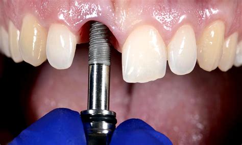 Complicaciones En Implantes Dentales Directorio Odontol Gico