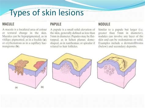 Types Of Skin Lesions Top 10 Most Aggressive Types Of Cancer Skin