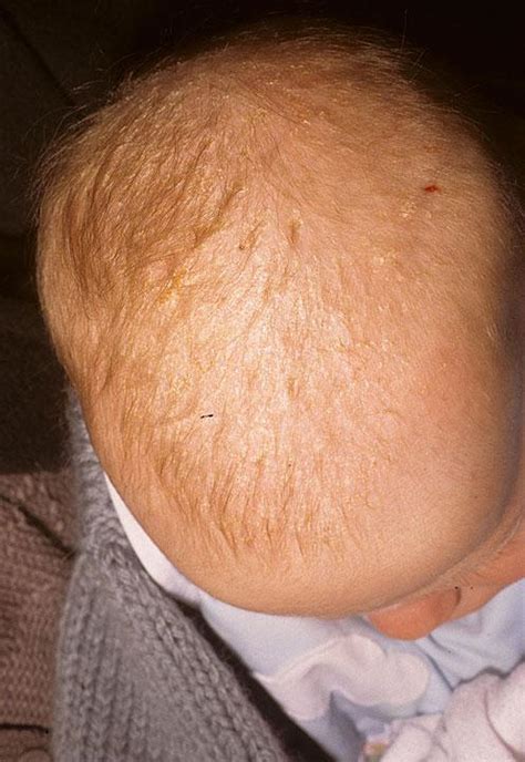 Baby Cradle Cap Pictures Symptoms Causes And Treatments Mommyhood101
