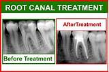 Photos of Insurance Cover Root Canal