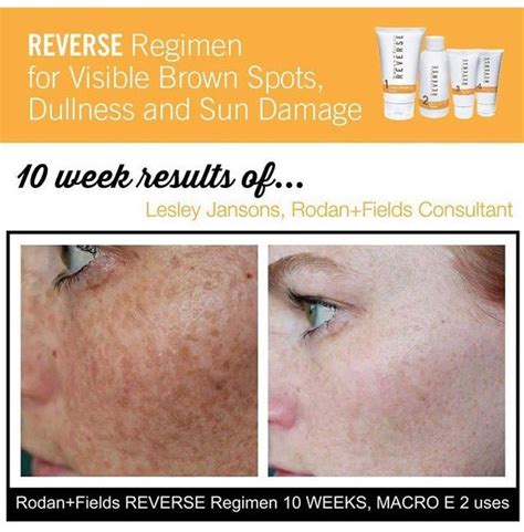 I Absolutely Love These Results What Can Your Skin Look Like After 10