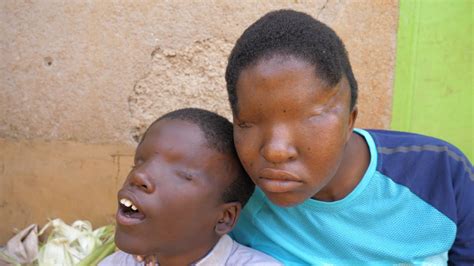 siblings born without eyes shocked everyone extraordinary people youtube