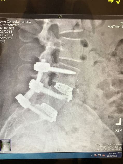 Spine Fusion X Ray X Ray Spines Spine Surgery