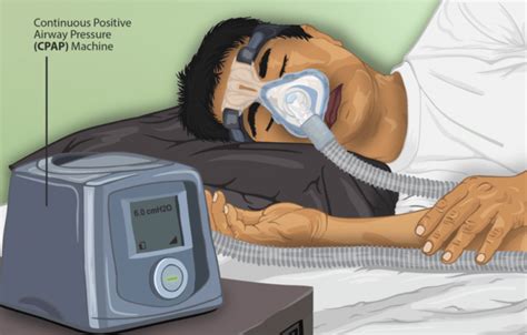 obstructive sleep apnea the battle for equal diagnosis dartmouth undergraduate journal of science