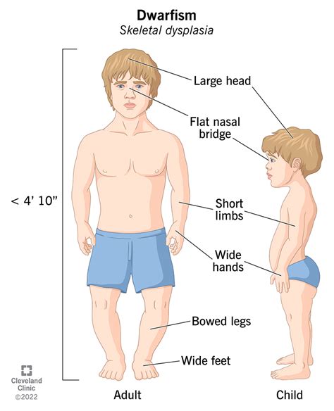 Dwarfism Skeletal Dysplasia Other Causes Of Short Stature