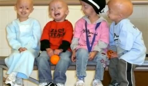 Progeria Life Expectancy Causes Symptoms Treatment