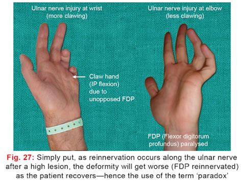 Ulnar Claw Hand