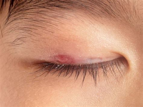 How To Treat Ingrown Eyelash Trichiasis 4 Treatments