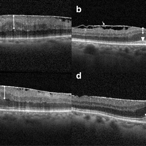 Spectral Domain Optical Coherence Tomography Showing Separated