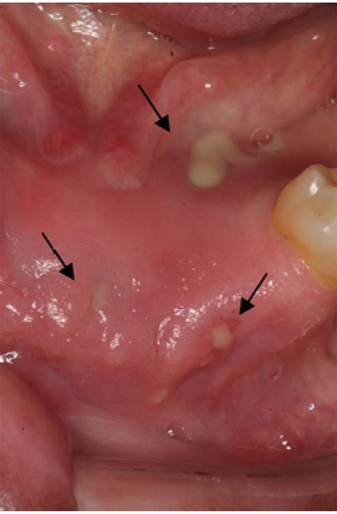 Common Benign Dental And Periodontal Lesions Intechopen