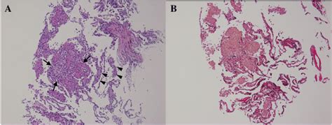 A Transbronchial Lung Biopsy Of Case Showed Fibrocellular Alveolitis