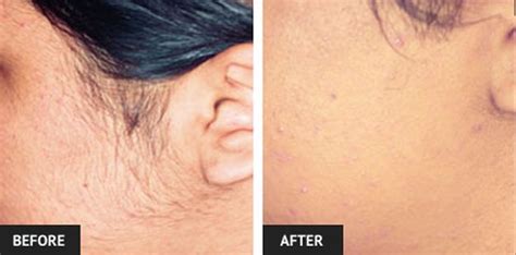 Laser Hair Removal Before And After Face