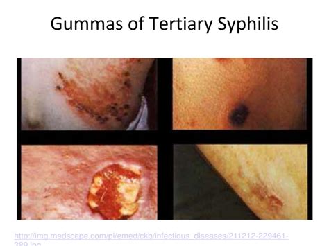 Ppt Syphilis Powerpoint Presentation Free Download Id3085470