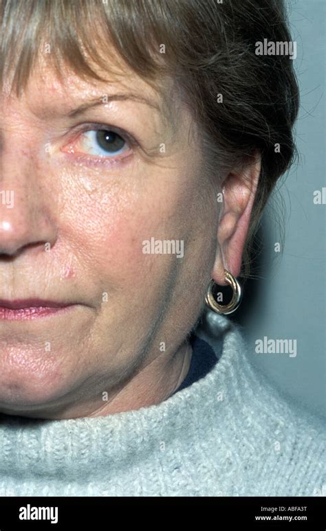 Enlarged Parotid Gland In Sjogrens Syndrome Other Features Are Dry