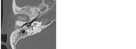 Cochlear Implantation In Patients With Eosinophilic Otitis Media