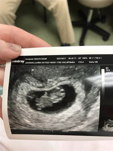 Never had any of this with my 3 other kids. 8 week 5 day ultrasound - Glow Community