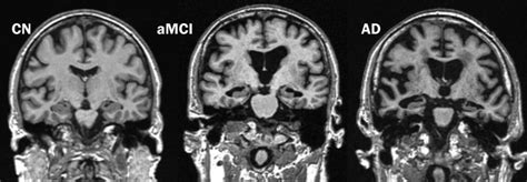 Role Of Structural Mri In Alzheimers Disease Disease Magnetic