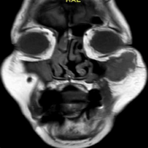 Head Mri Shows Well Defined Lobulated Soft Tissue Mass Noted At The