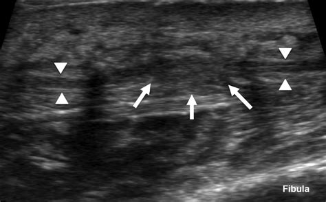 Sonographic Evaluation Of Superficial Peroneal Nerve Abnormalities Ajr
