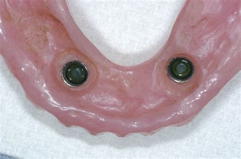 Dental Implants for Dentures | Dental Implants for Dentures - Kazemi