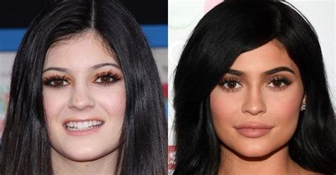 kylie jenner before and after kylie jenner kylie kylie plastic surgery