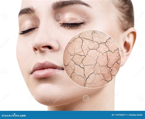 Zoom Circle Shows Dry Facial Skin Before Moistening Stock Image