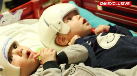 risky surgery separates 10 month old from parasitic twin cnn