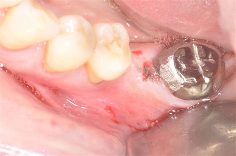 New Technique Flapless Crest Splitting For A Mandibular Narrow Ridge