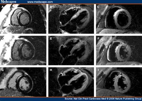 Diagnostic performance of cardiovascular magnetic resonance in patients with suspected acute myocarditis: Tubercular Myocarditis Presenting With Ventricular Tachycardia