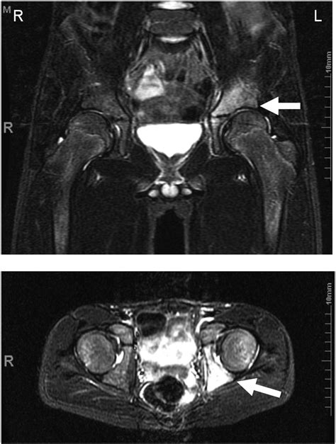 Magnetic Resonance Imaging T2 Of The Pelvis Taken On Day 8 Of Download Scientific Diagram