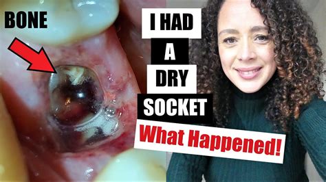 My Dry Socket Experience After Tooth Extraction How I Treated It What A