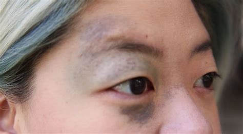 Woman With Prominent Black Eye Birthmark Often Mistaken For Bruise