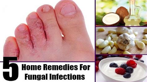 5 Ways You Can Treat Fungal Infections At Home By Top 5 Youtube