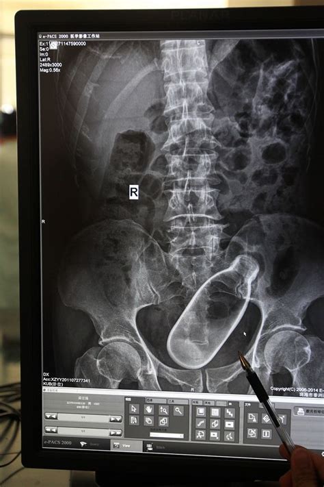 Shocking Hospital X Ray Shows Man With Bottle Stuck Inside Him Mirror